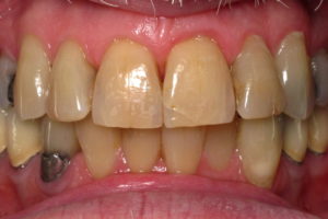 テトラサイクリン歯の症例３