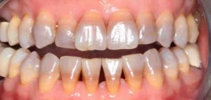 テトラサイクリン歯の症例4