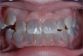 テトラサイクリン歯の症例2