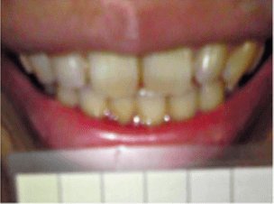 ファストホワイトで歯を白くするホワイトニング前の歯