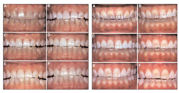テトラサイクリン歯のホワイトニング臨床結果