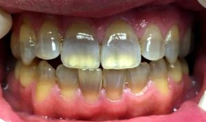 テトラサイクリン歯の症例