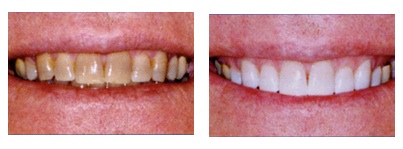テトラサイクリン歯のホワイトニング症例