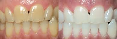 テトラサイクリン歯のホワイトニング症例