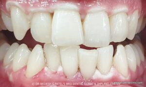 ホワイトニングで出来る火傷